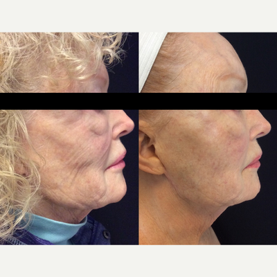Sculptra before and after photo