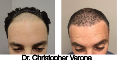 Hair Transplant before and after photo