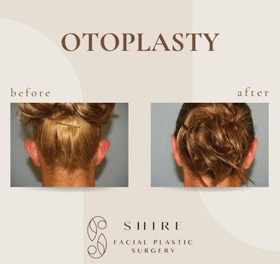 Ear Surgery before and after photo