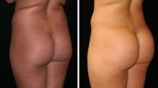 Butt Augmentation before and after photo