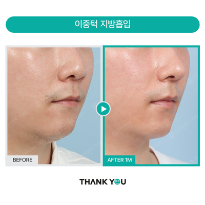 Chin Liposuction before and after photo