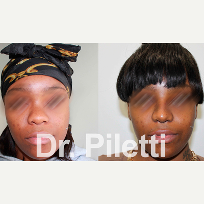 African American Rhinoplasty before and after photo