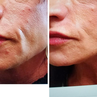 Dermal Fillers before and after photo