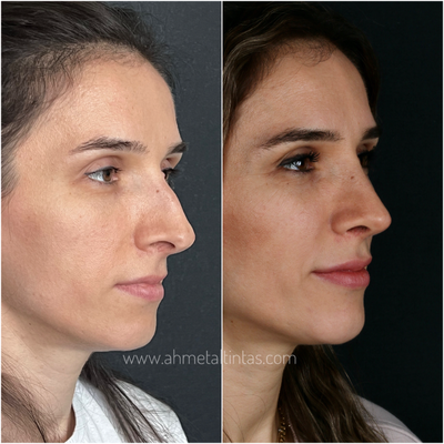 Rhinoplasty before and after photo