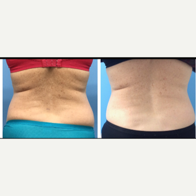 CoolSculpting before and after photo