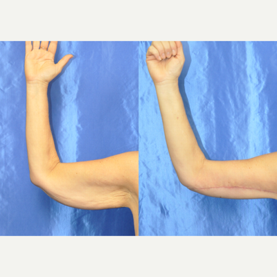 Arm Lift before and after photo