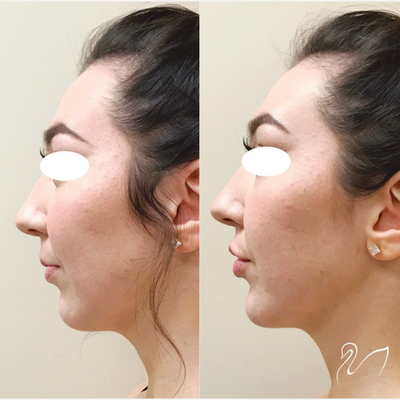 Dermal Fillers before and after photo