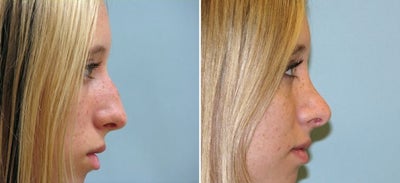 Rhinoplasty before and after photo