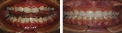 Invisalign before and after photo