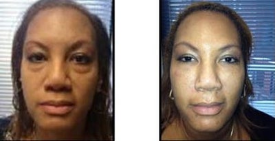 Juvederm before and after photo