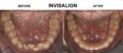 Invisalign before and after photo