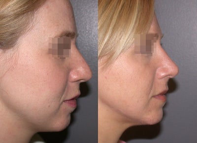 Rhinoplasty before and after photo