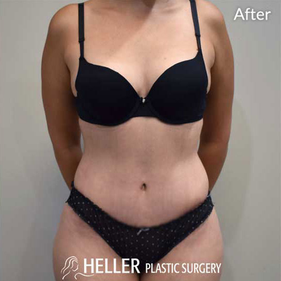 Justin Heller, MD Reviews, Before and After Photos, Answers - RealSelf