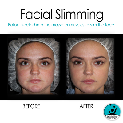 Botox before and after photo
