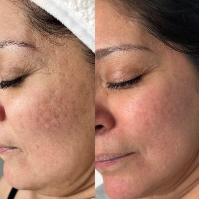 Chemical Peel before and after photo