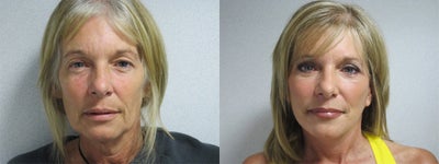 Facelift before and after photo