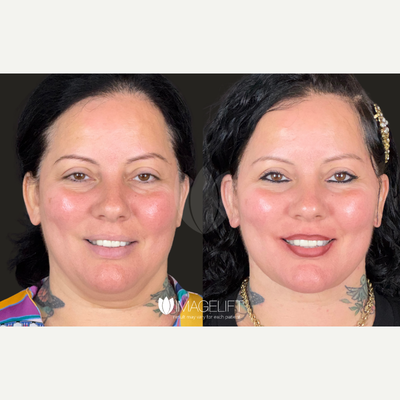 Sculptra before and after photo