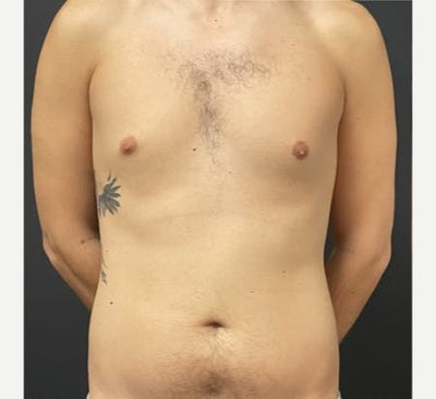 Vaser Liposuction before and after photo