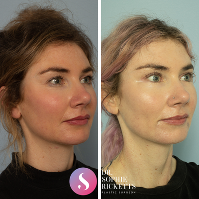 Eyelid Surgery before and after photo