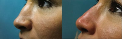 Restylane before and after photo