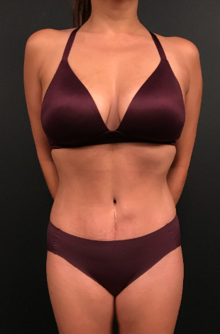 Remus Repta MD - Tummy tuck revisions are a little bit more challenging,  but we like a challenge! This patient was unhappy with her overall shape,  scar placement and had some scar