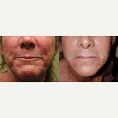 Dermal Fillers before and after photo