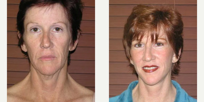 Female treated for signs of aging - Female patient treated for signs of aging in the lower face and neck