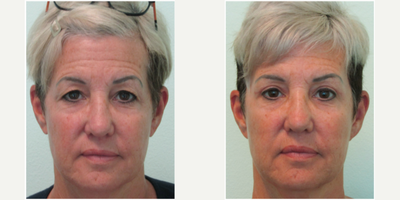 55-64 year old woman treated with Lateral Brow Lift and Upper Blepharoplasty/Eyelid Lift - This middle-aged woman presented with the concerns of excessively heavy upper eyelids.   She stated that her aging was certainly genetic in nature, for her mother and grandmother had aged in the same fashion.  She stated that she had tried botox on numerous occasions with minimal improvement.  She presented with the desire for more permanent results and longevity.Examination demonstrated moderate to severe excessive thin skin over the eyelids along with mild/moderate drooping of the outer eyebrows.  We also noted that her right eye was slightly droopier appearing than the left.  We decided together to perform both an upper blepharoplasty and lateral brow lift.Only under local anesthesia and mild oral sedation with valium, we performed both procedures at the same time in our office.  Procedure time was under 1 1/2 hours, and all stitches were removed 6 days afterwards.Her results demonstrate a significantly bright-eyed appearance while maintaining a natural look.  She stated her actual vision was somewhat improved, and makeup application was easier.