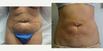 25-34 year old woman treated with Body Jet - Body Jet liposuction by Dr. Dinc