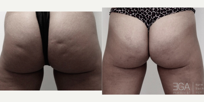 25-34 year old woman treated with Cellfina - Celfina. This is the only FDA cleared minimally invasive one time procedure clinically proven to improve the appearance of cellulite for at least three years .