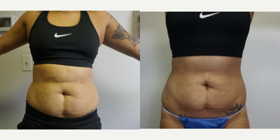 25-34 year old woman treated with Body Jet - Body jet liposuction for love handles.