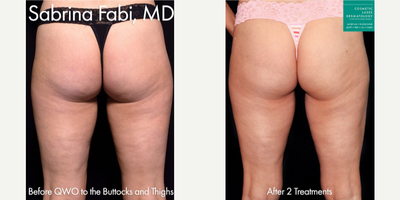 25-34 year old woman treated with Qwo - Qwo use to to treat cellulite on the buttocks of a female patient by Dr. Fabi.