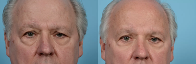 Man treated with Brow Lift - Man treated with Brow Lift