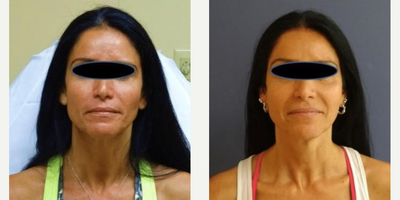 Woman treated with Botox, Dermal Fillers, Fractora RF, Microdermabrasion - Woman treated with Botox, Dermal Fillers, Fractora RF, Microdermabrasion
