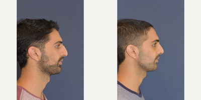 18-24 year old man treated with Rhinoplasty - Before and after rhinoplasty and septoplasty surgery