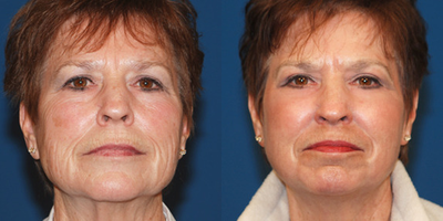 60 - 70 Year Old Female - Surgical Procedure: Full Face CO2 Laser Resurfacing - Moderate. This patient came to Plastic Surgery Associates wanting an improvement in skin texture and wrinkling.
