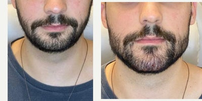 35-44 year old man treated with Dermal Fillers, Micro Botox - TMJ Toxin and Dermal Filler placements with Aubrey Houchin