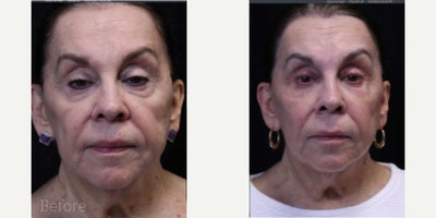 Patient treated with UltraClear Laser - Patient treated with UltraClear Laser