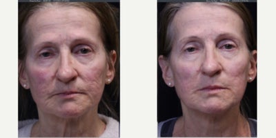 Patient treated with UltraClear Laser - Patient treated with UltraClear Laser