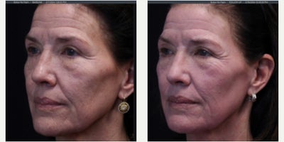 Woman treated with UltraClear Laser - Woman treated with UltraClear Laser