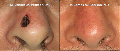 Nose Reconstruction / Mohs Reconstruction - 
	Nose Reconstruction / Mohs Reconstruction
