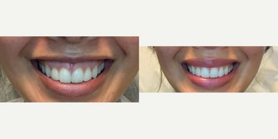 25-34 year old woman treated with Botox, Botox for Gummy Smile - Treated by Aubrey Houchin, RN