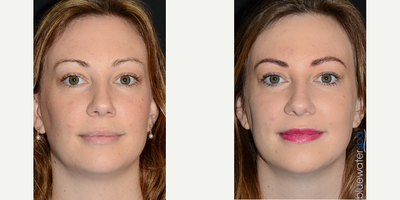 25-34 year old woman treated with Microblading - Microblading treatment of the eyebrows.