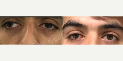 Man treated with Strabismus Surgery - Man treated with Strabismus Surgery