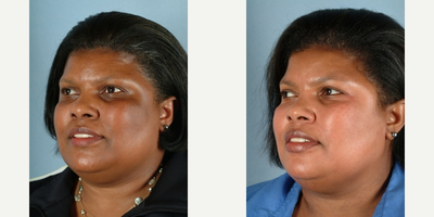 35-44 year old woman treated with Obagi Nu-Derm - 35-44 year old woman treated with Obagi Nu-Derm
