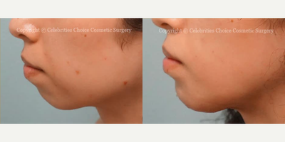 Woman treated with Chin Implant, Chin Filler - This patient had Chin Augmentation with an Implant (2 weeks post-operation).
