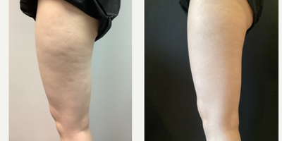 25-34 year old woman treated with Exilis - 1 treatment of Exilis.