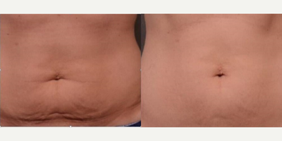 35-44 year old woman treated with Secret RF - Mother of two Caucasian female treated with Secret FR with PRP (Microneedling RF with PRP). Post photo was taken 3 months after the fourth treatment.