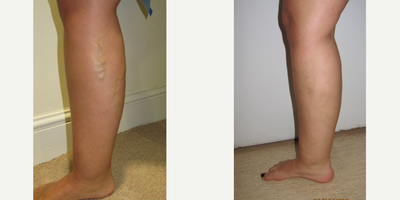 18-24 year old woman treated with VenaSeal - Glue treatment under local anaesthetic