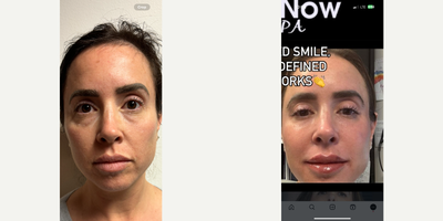 35-44 year old woman treated with IPL, Semaglutide, Voluma, Lip Fillers, Revanesse, Skin Tightening, Skin Rejuvenation, Botox, S - IPL-Hyperpigmentation lighteningPRP-Under eye hollowing and darknessPlasmage- Elimination of wrinkles around the eyesMorpheus Microneedling- Skin tightening and retexturizingLip filler and Botox- Turning down turned smile up!